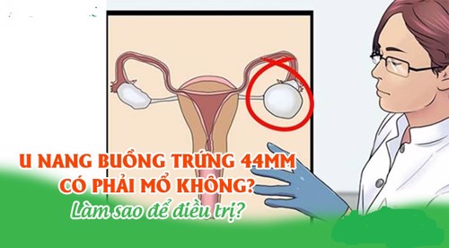 U nang buồng trứng 44mm có phải mổ không? Làm sao để điều trị?